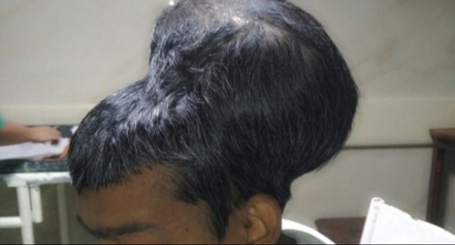 Энэтхэг залуугийн тархинаас 1.8 кг жинтэй хавдар авчээ