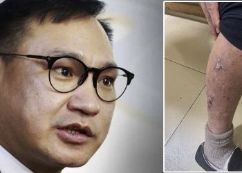 ШШГЕГ: Б.Ганхуягийн хөлийн шилбэний өөрчлөлт нь цагдан хоригдохоор ирэх үеийнхээс нэмэгдээгүй