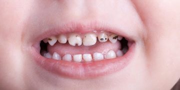 Монголд 10 хүүхэд тутмын 4-6 нь шүдээ эмчлүүлэх шаардлагатай