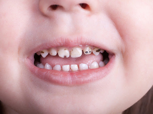 Монголд 10 хүүхэд тутмын 4-6 нь шүдээ эмчлүүлэх шаардлагатай
