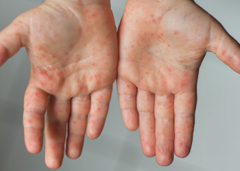 Улаанбурхан өвчний улмаас нэг хүн нас баржээ